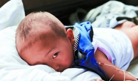 新生儿吸吮无力是最严重的脑瘫吗